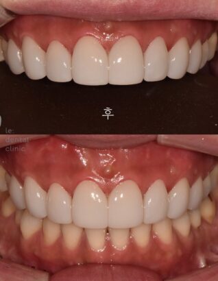 ラミネート AFTER