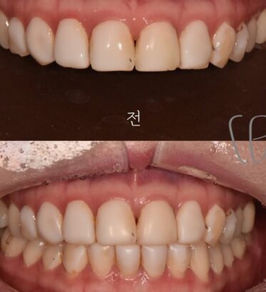 ラミネート BEFORE