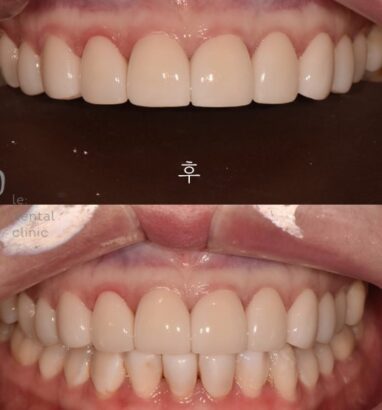 ラミネート AFTER