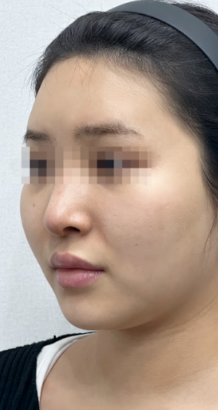 シュリンク BEFORE