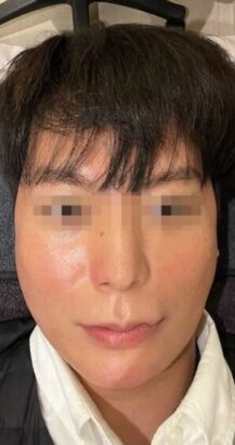 ウルセラ BEFORE
