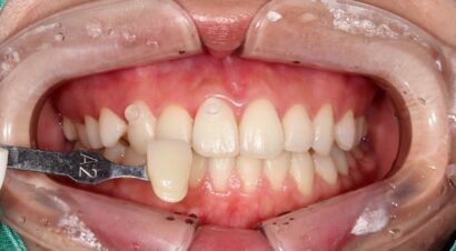 ホワイトニング3回照射 BEFORE