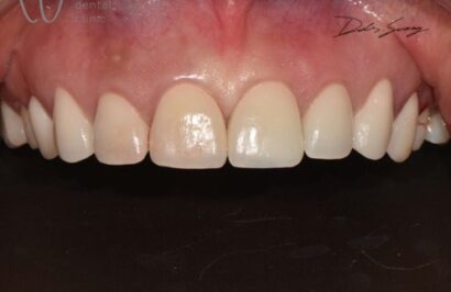 歯茎治療 AFTER