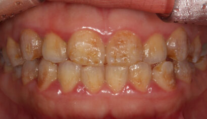 ラミネートべニア BEFORE