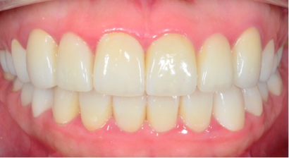 ラミネートべニア AFTER