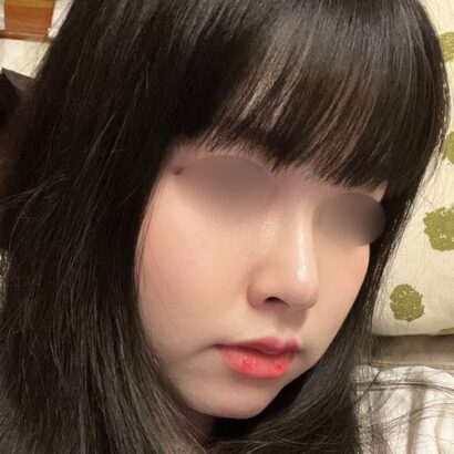 鼻整形 2ヶ月後 AFTER