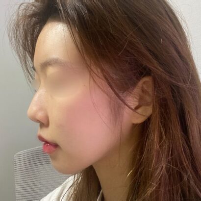鼻整形 3ヶ月後 BEFORE