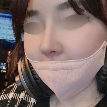 鼻整形 3ヶ月後 AFTER