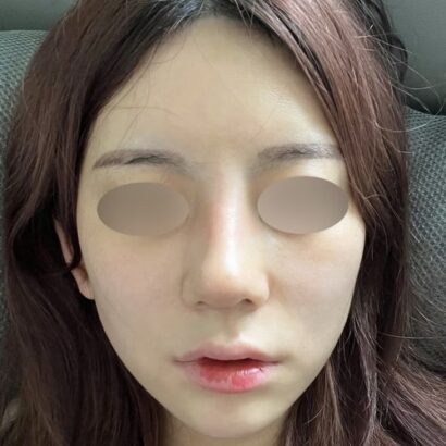鼻整形 2週間後 BEFORE