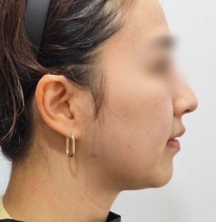 ソフウェーブ BEFORE