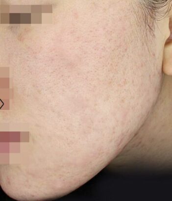 ニキビ治療 AFTER