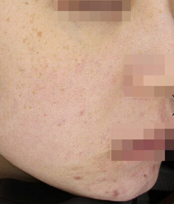 ニキビ治療 BEFORE