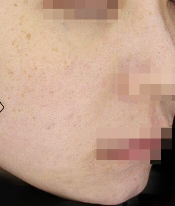 ニキビ治療 AFTER