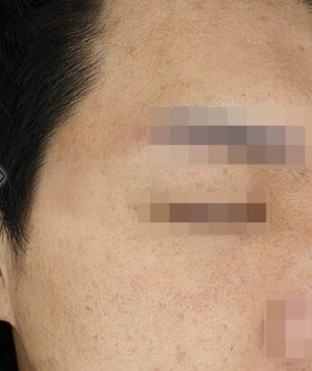 ニキビ治療 AFTER