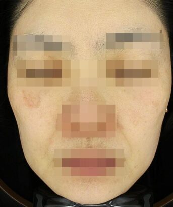 リフティング BEFORE