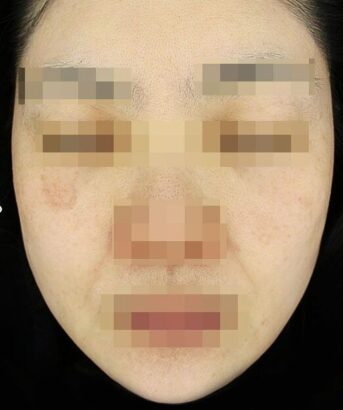 リフティング AFTER