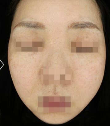 リフティング AFTER