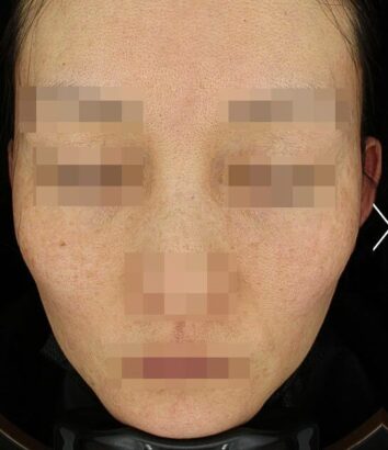 リフティング BEFORE