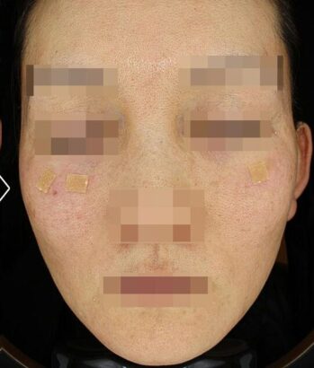 リフティング AFTER