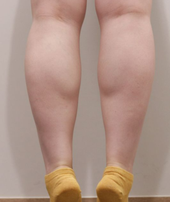 ふくらはぎ BEFORE