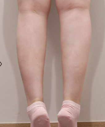 ふくらはぎ AFTER