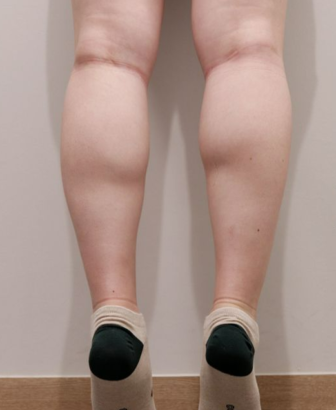 ふくらはぎ BEFORE