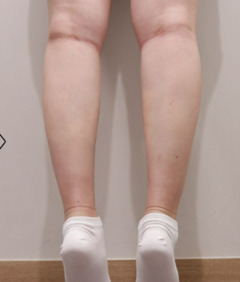ふくらはぎ AFTER