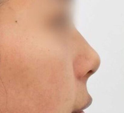 鼻フィラー（ジュビダーム） BEFORE