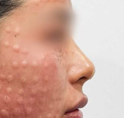 鼻フィラー（ジュビダーム） AFTER