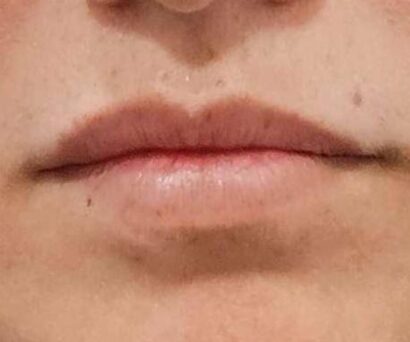 唇フィラー（ベロテロ） BEFORE