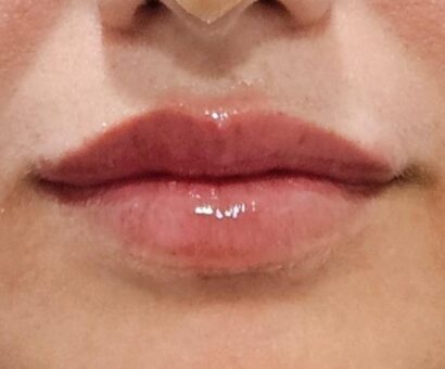 唇フィラー（ベロテロ） AFTER