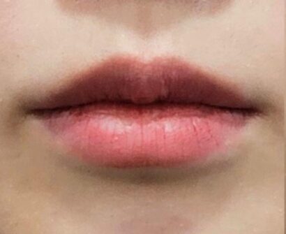 唇フィラー（ジュビダーム） BEFORE