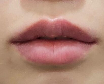 唇フィラー（ジュビダーム） AFTER