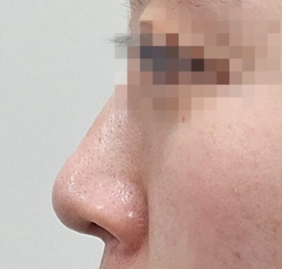 鼻フィラー（ジュビダーム） BEFORE