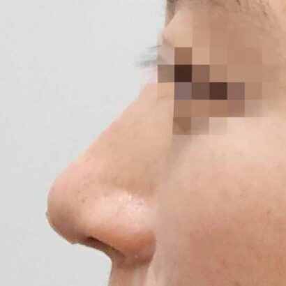 鼻フィラー（ジュビダーム） AFTER