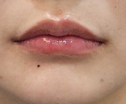 唇フィラー（ジュビダーム） AFTER