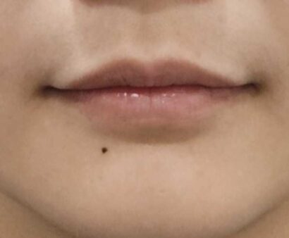 唇フィラー（ジュビダーム） BEFORE