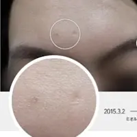 真皮再生鍼 BEFORE