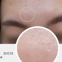 真皮再生鍼 AFTER