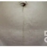 肉割れ治療 BEFORE