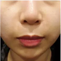 Vリフティング埋線 AFTER