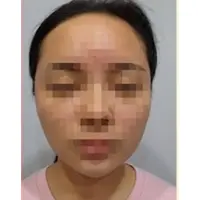 Vリフティング埋線 AFTER