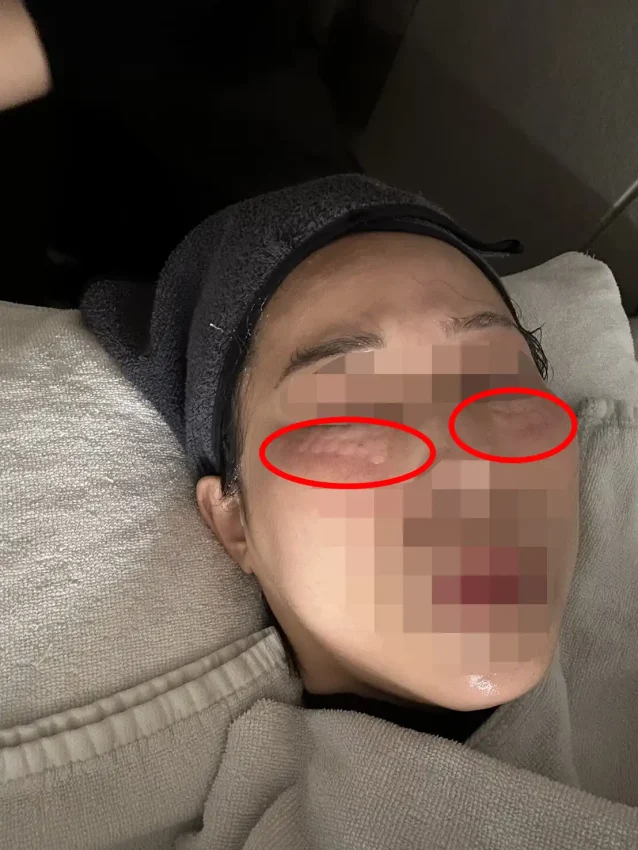 リベリクリニックダウンタイム