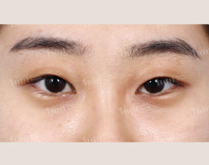 二重切開、目上切開、目尻切開、たれ目形成 BEFORE