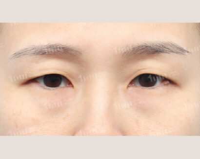 二重整形（自然癒着） BEFORE