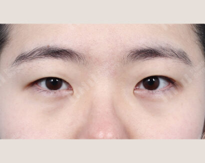 非切開目つき矯正、瞼の脂肪除去、目頭切開 BEFORE