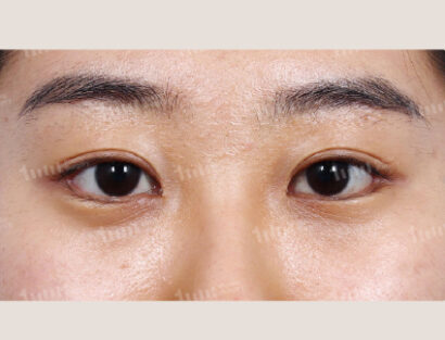 二重切開、目上切開、目尻切開、たれ目形成 AFTER