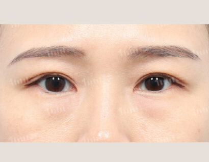 二重整形（自然癒着） AFTER