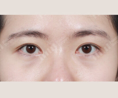 非切開目つき矯正、瞼の脂肪除去、目頭切開 AFTER