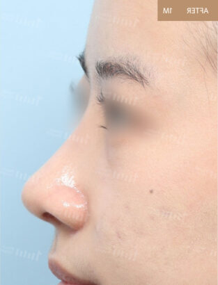 鼻筋プロテーゼ、鼻尖形成、鼻中隔延長、小鼻縮小 AFTER